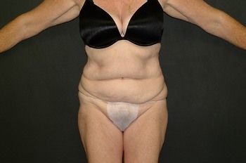 Abdominoplasty Before & After Patient 03