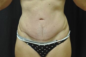 Abdominoplasty Before & After Photo Patient 05 Thumbnail