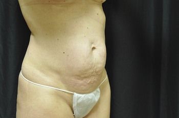 Abdominoplasty Before & After Patient 05