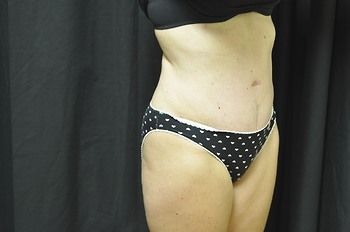 Abdominoplasty Before & After Photo Patient 05 Thumbnail