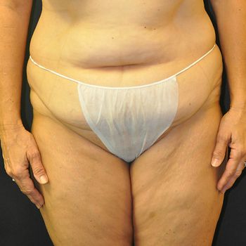 Abdominoplasty Before & After Patient 06