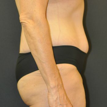 Abdominoplasty Before & After Patient 06