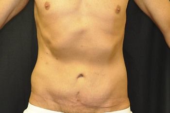 Abdominoplasty Before & After Photo