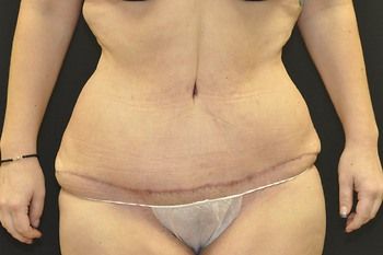 Abdominoplasty Before & After Patient 08