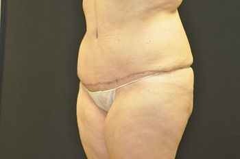 Abdominoplasty Before & After Patient 08