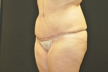 Abdominoplasty Before & After Photo Patient 08 Thumbnail