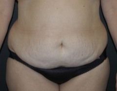 Abdominoplasty Before & After Patient 09