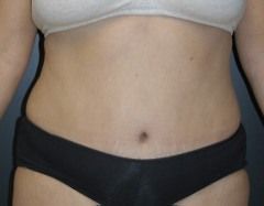 Abdominoplasty Before & After Patient 09