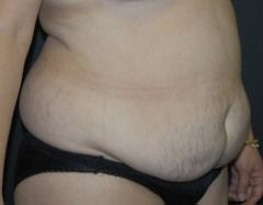 Abdominoplasty Before & After Patient 09