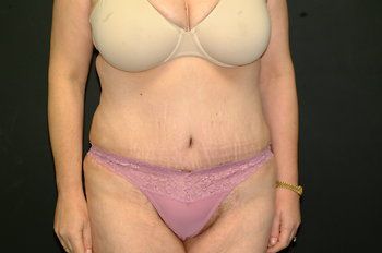Abdominoplasty Before & After Patient 12