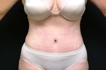 Abdominoplasty Before & After Patient 13