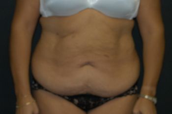 Abdominoplasty Before & After Patient 14