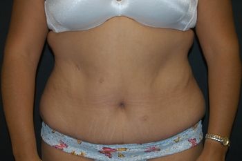 Abdominoplasty Before & After Photo Patient 14 Thumbnail