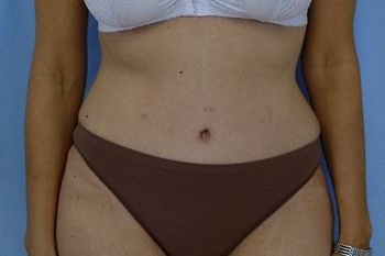 Abdominoplasty Before & After Patient 15