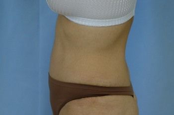 Abdominoplasty Before & After Patient 15