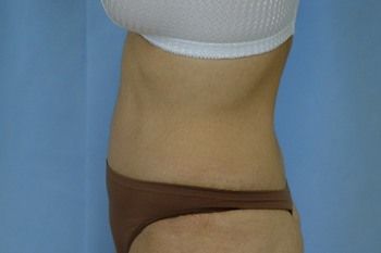 Abdominoplasty Before & After Photo Patient 15 Thumbnail