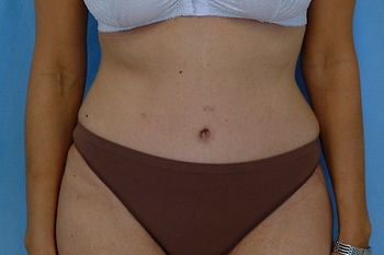 Abdominoplasty Before & After Patient 16