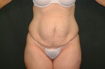 Abdominoplasty Before & After Patient 17