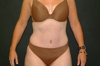 Abdominoplasty Before & After Photo Patient 17 Thumbnail