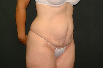 Abdominoplasty Before & After Photo Patient 17 Thumbnail