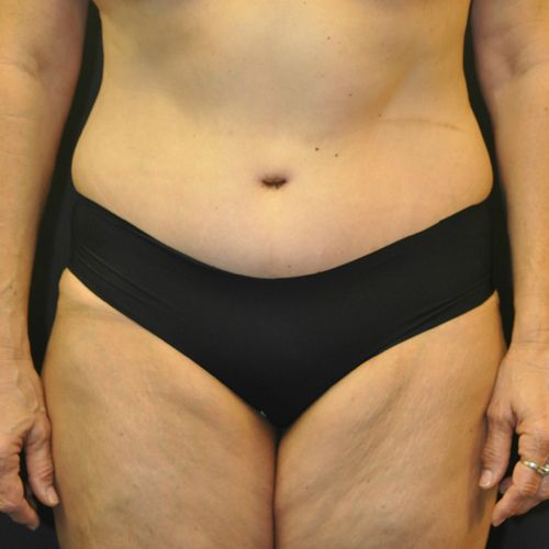 Abdominoplasty Before & After Photo Patient 21 Thumbnail