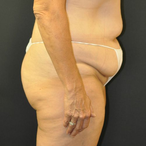 Abdominoplasty Before & After Patient 21