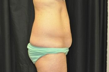 Abdominoplasty Before & After Patient 22