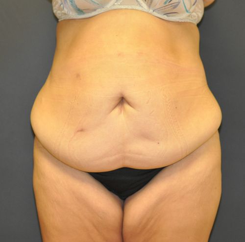 Abdominoplasty Before & After Photo Patient 23 Thumbnail