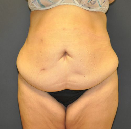 Abdominoplasty Before & After Patient 23