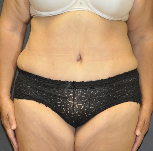 Abdominoplasty Before & After Photo Patient 23 Thumbnail