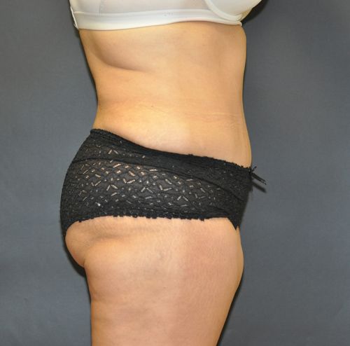 Abdominoplasty Before & After Photo Patient 23 Thumbnail