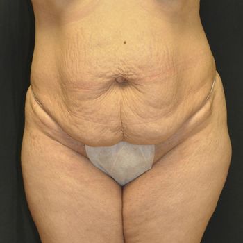 Abdominoplasty Before & After Photo Patient 24 Thumbnail