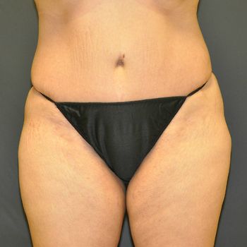 Abdominoplasty Before & After Photo Patient 24 Thumbnail