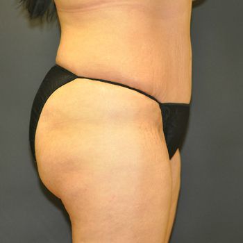 Abdominoplasty Before & After Patient 24