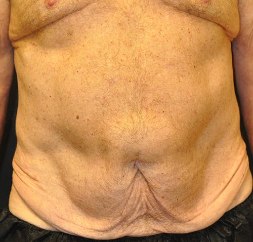 Abdominoplasty Before & After Patient 25