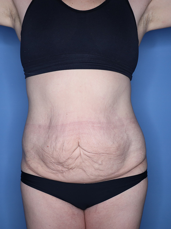 Abdominoplasty Before & After Patient 26