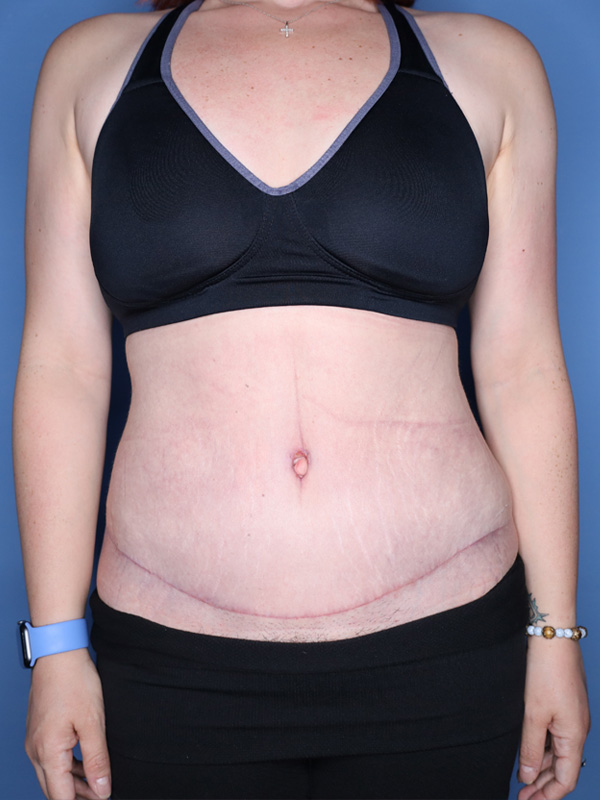 Abdominoplasty Before & After Patient 26