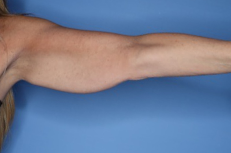 Brachioplasty Before & After Patient 02
