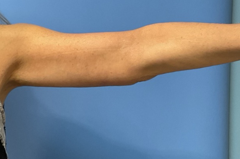 Brachioplasty Before & After Patient 02