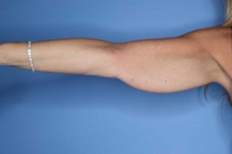 Brachioplasty Before & After Patient 02
