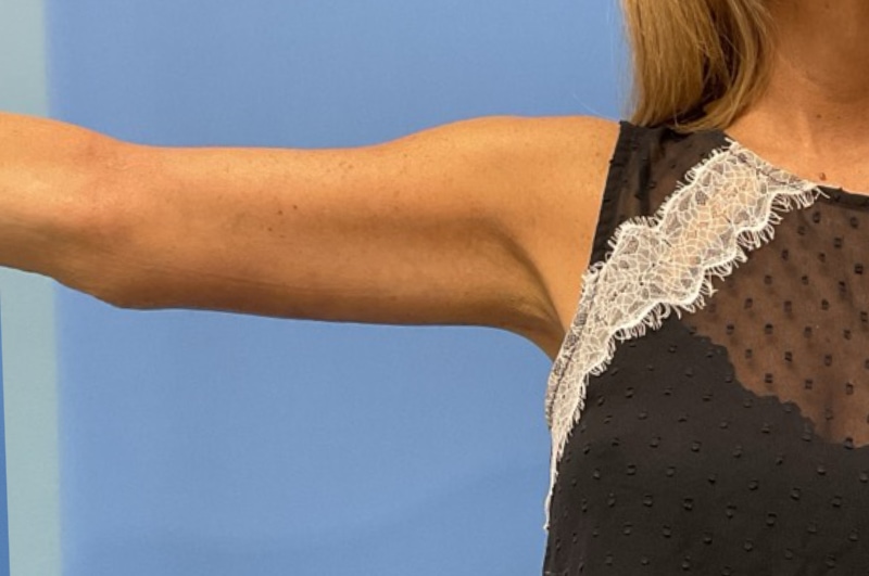 Brachioplasty Before & After Patient 02