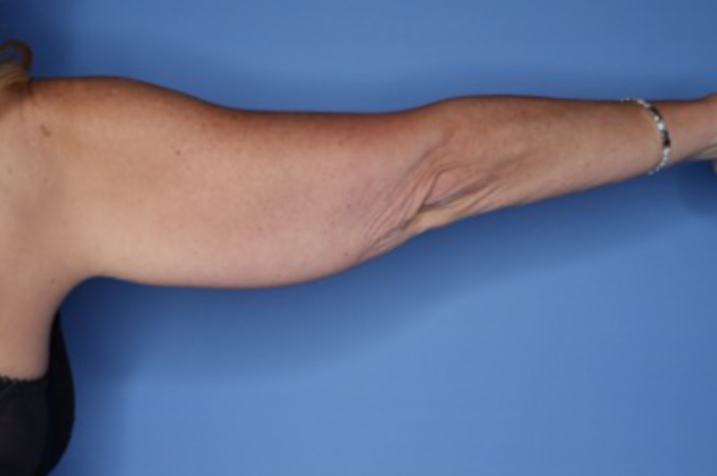 Brachioplasty Before & After Patient 02