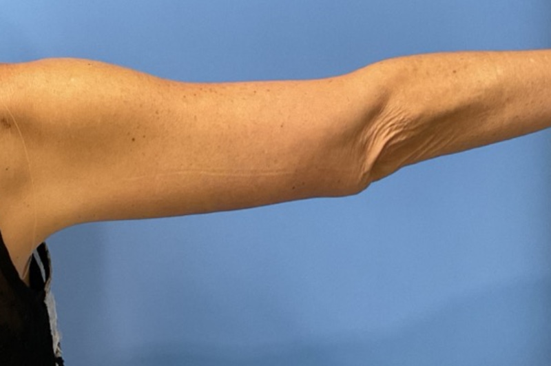 Brachioplasty Before & After Patient 02