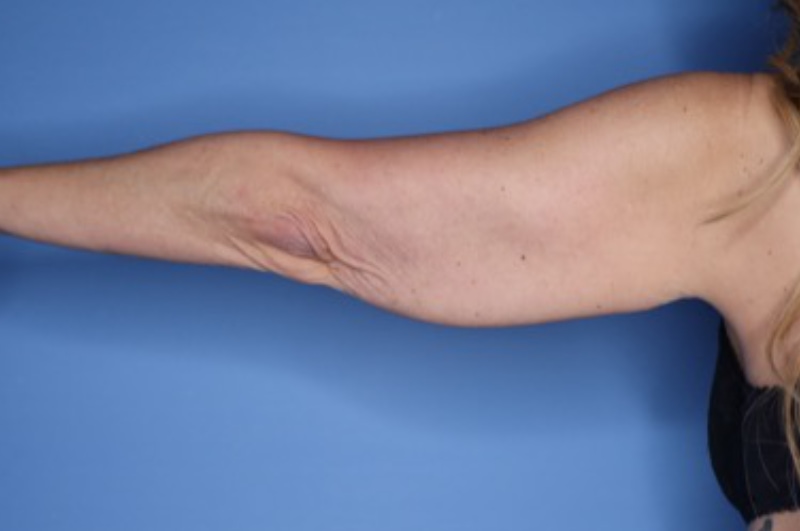 Brachioplasty Before & After Patient 02