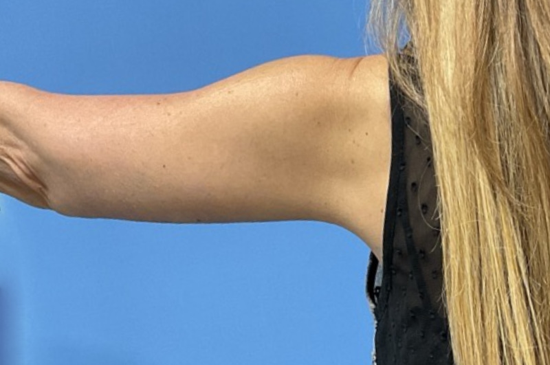 Brachioplasty Before & After Patient 02