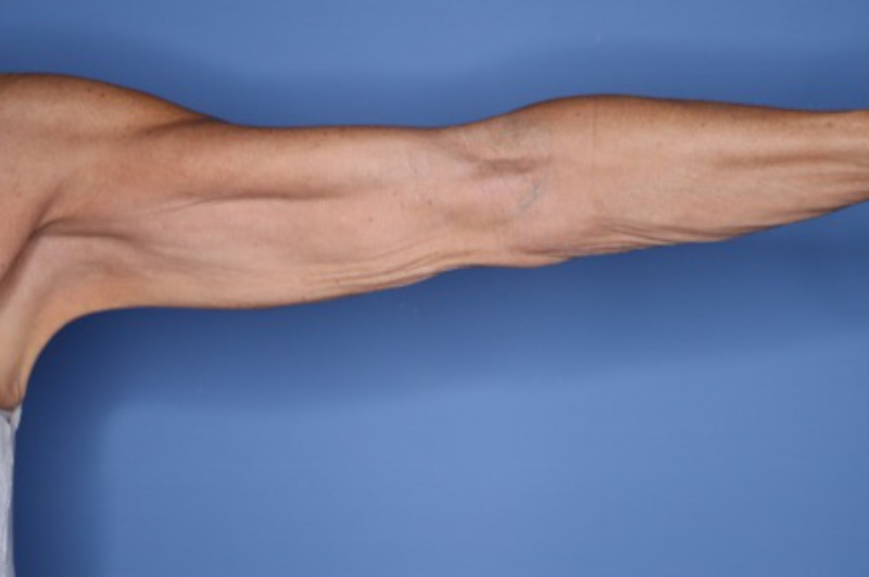 Brachioplasty Before & After Patient 03