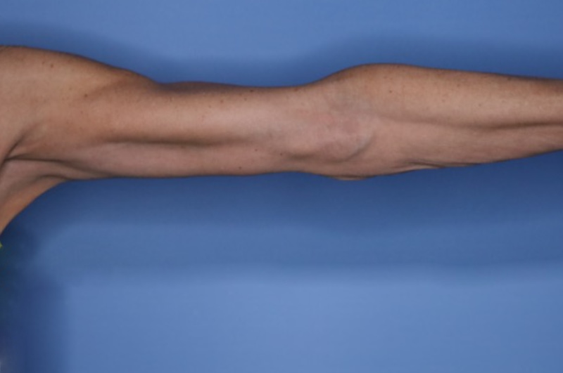 Brachioplasty Before & After Patient 03
