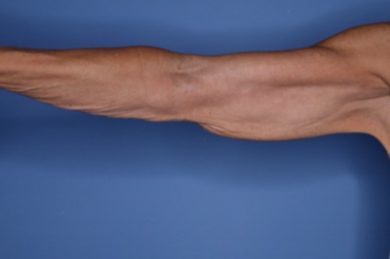Brachioplasty Before & After Patient 03