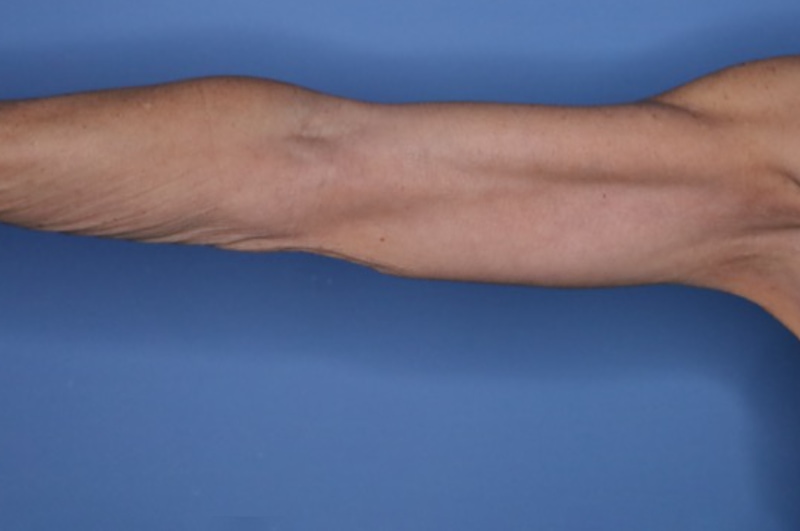 Brachioplasty Before & After Patient 03