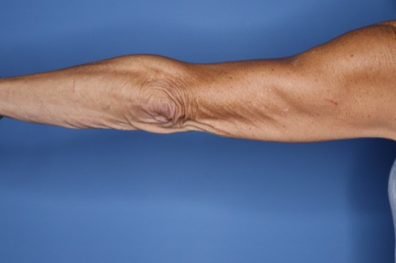 Brachioplasty Before & After Patient 03